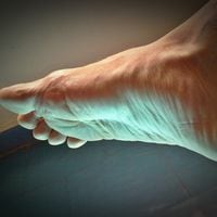 ¿Qué tan peligroso son los pies planos? Esto concluyó un nuevo estudio científico