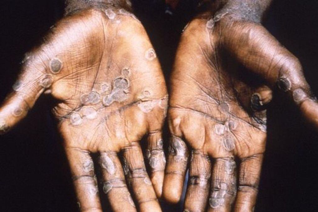 The palms of a monkeypox case patient from Lodja, a city located within the Katako-Kombe Health Zone, are seen during a health investigation in the Democratic Republic of Congo in 1997. Picture taken in 1997. Brian W.J. Mahy/CDC/Handout via REUTERS. THIS IMAGE HAS BEEN SUPPLIED BY A THIRD PARTY. IT IS DISTRIBUTED, EXACTLY AS RECEIVED BY REUTERS, AS A SERVICE TO CLIENTS